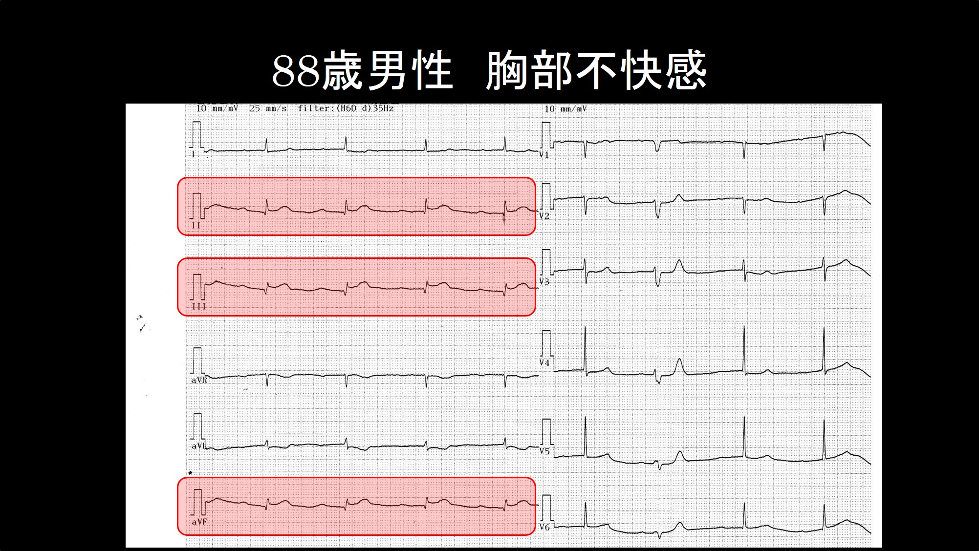 心筋梗塞の心電図：ST上がってますか？ | こっそりEBM勉強会