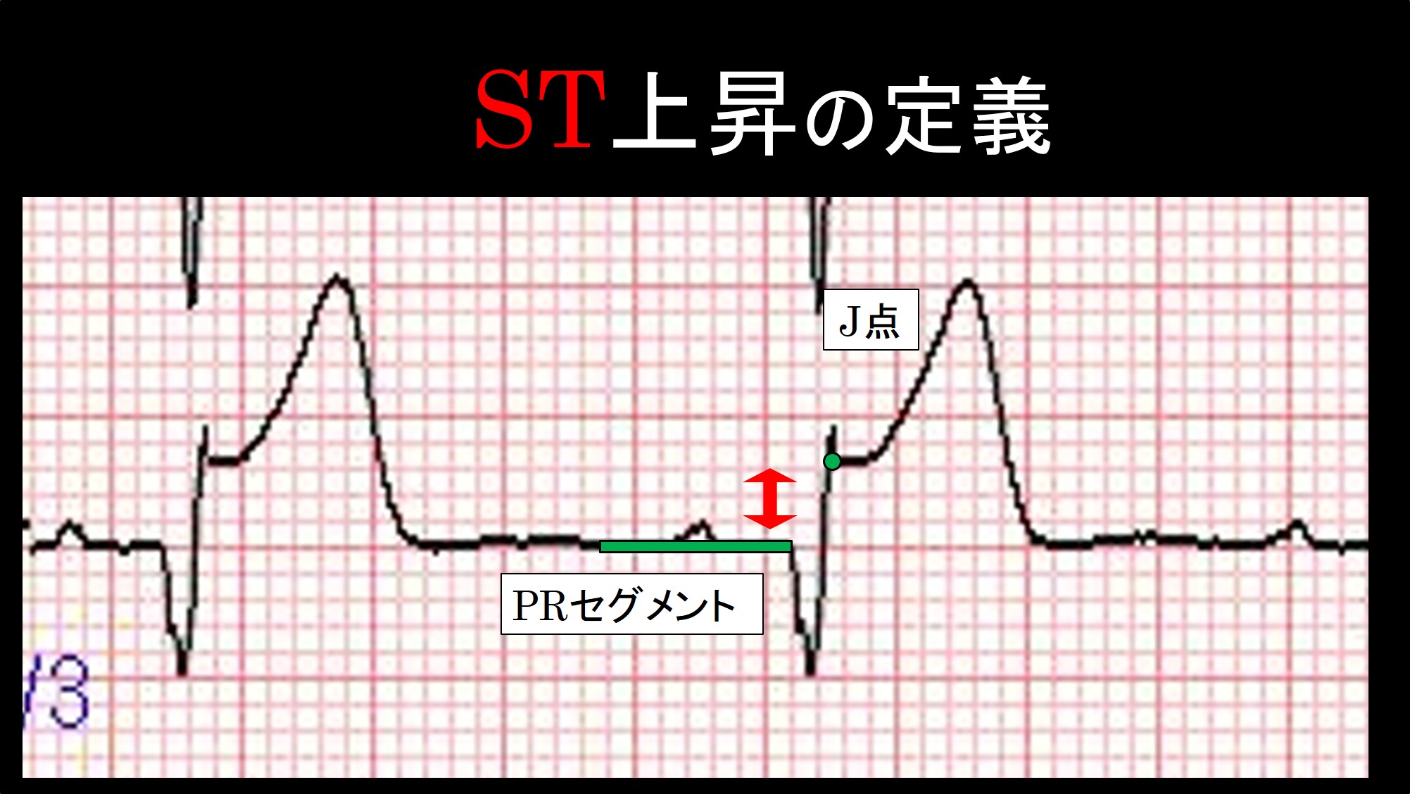 心筋梗塞の心電図：ST上がってますか？ | こっそりEBM勉強会