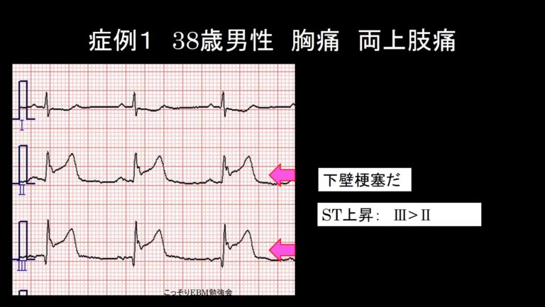心筋梗塞の心電図：下壁梗塞 | こっそりEBM勉強会