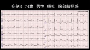 心筋梗塞の心電図：側壁梗塞 | こっそりEBM勉強会