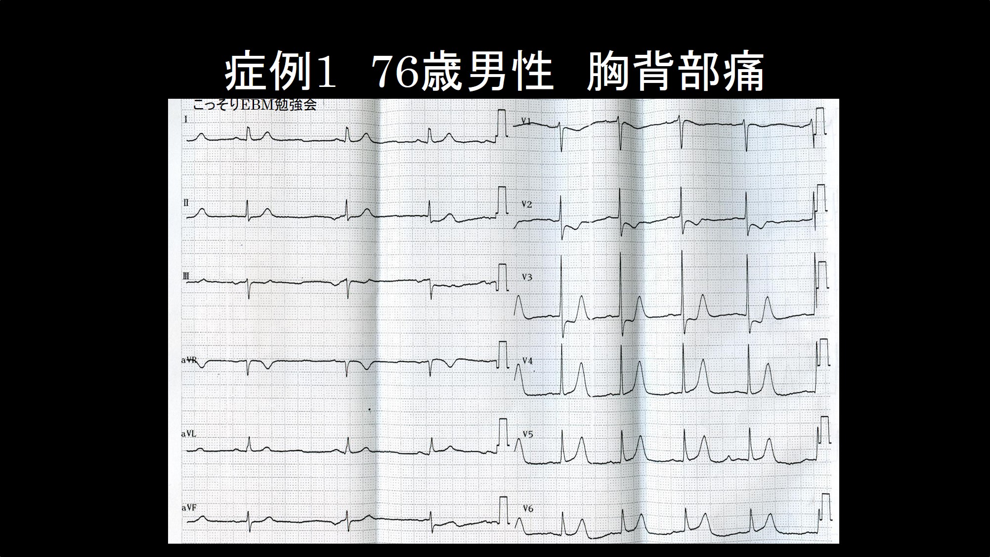 心筋梗塞の心電図：後壁梗塞 | こっそりEBM勉強会