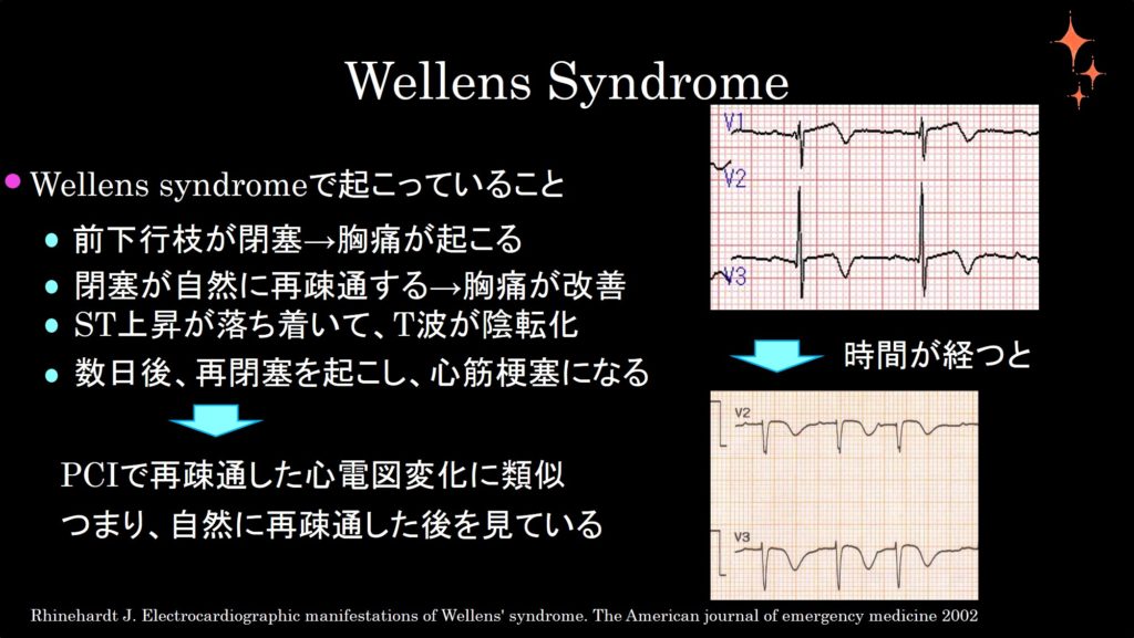 Wellens Syndrome