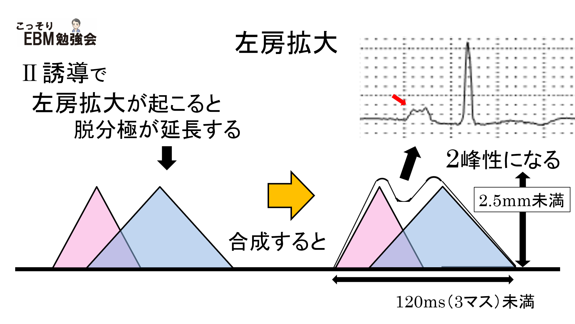 【心電図】左房拡大 | こっそりEBM勉強会