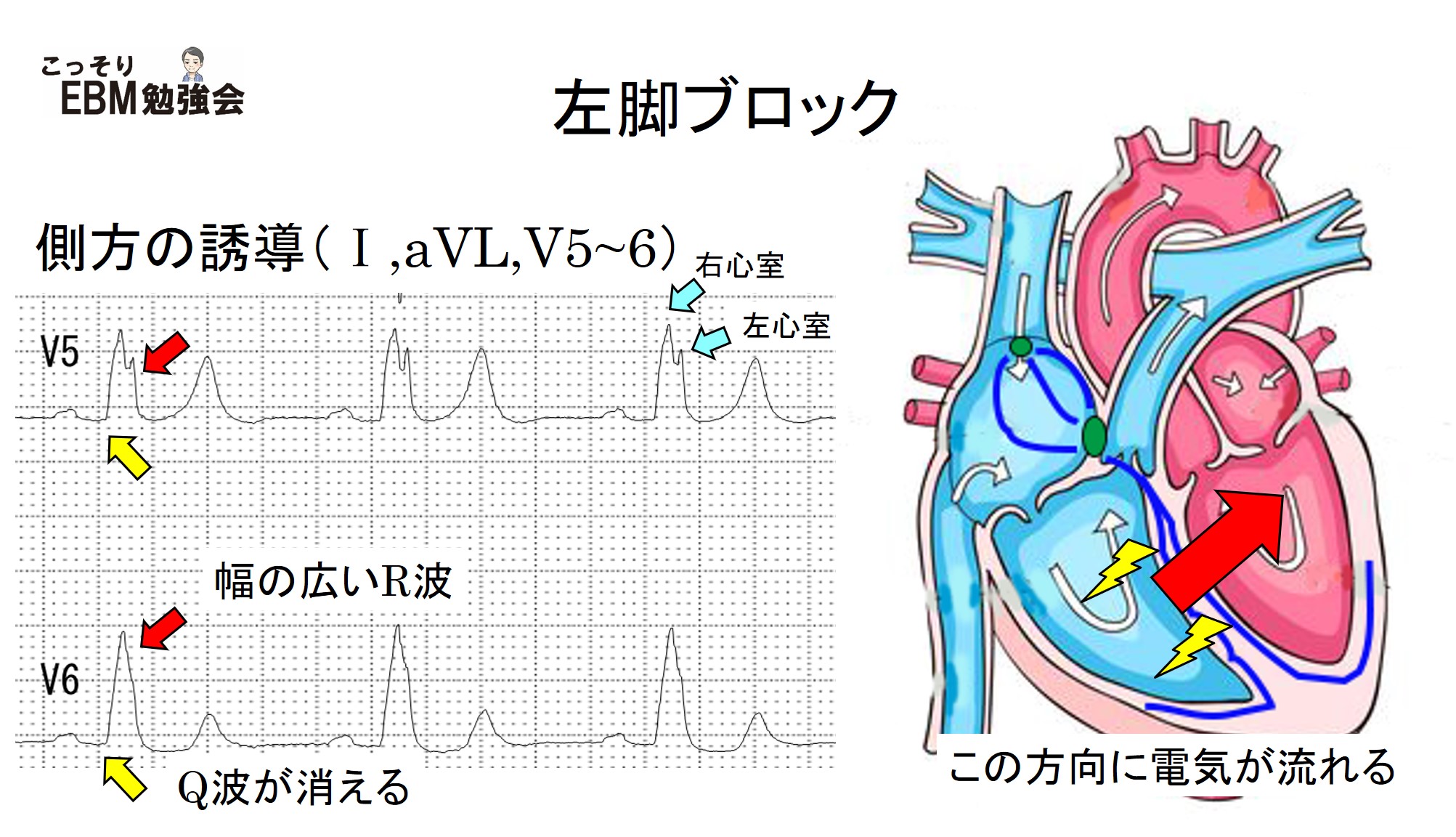 分かる！左脚ブロックの心電図 | こっそりEBM勉強会
