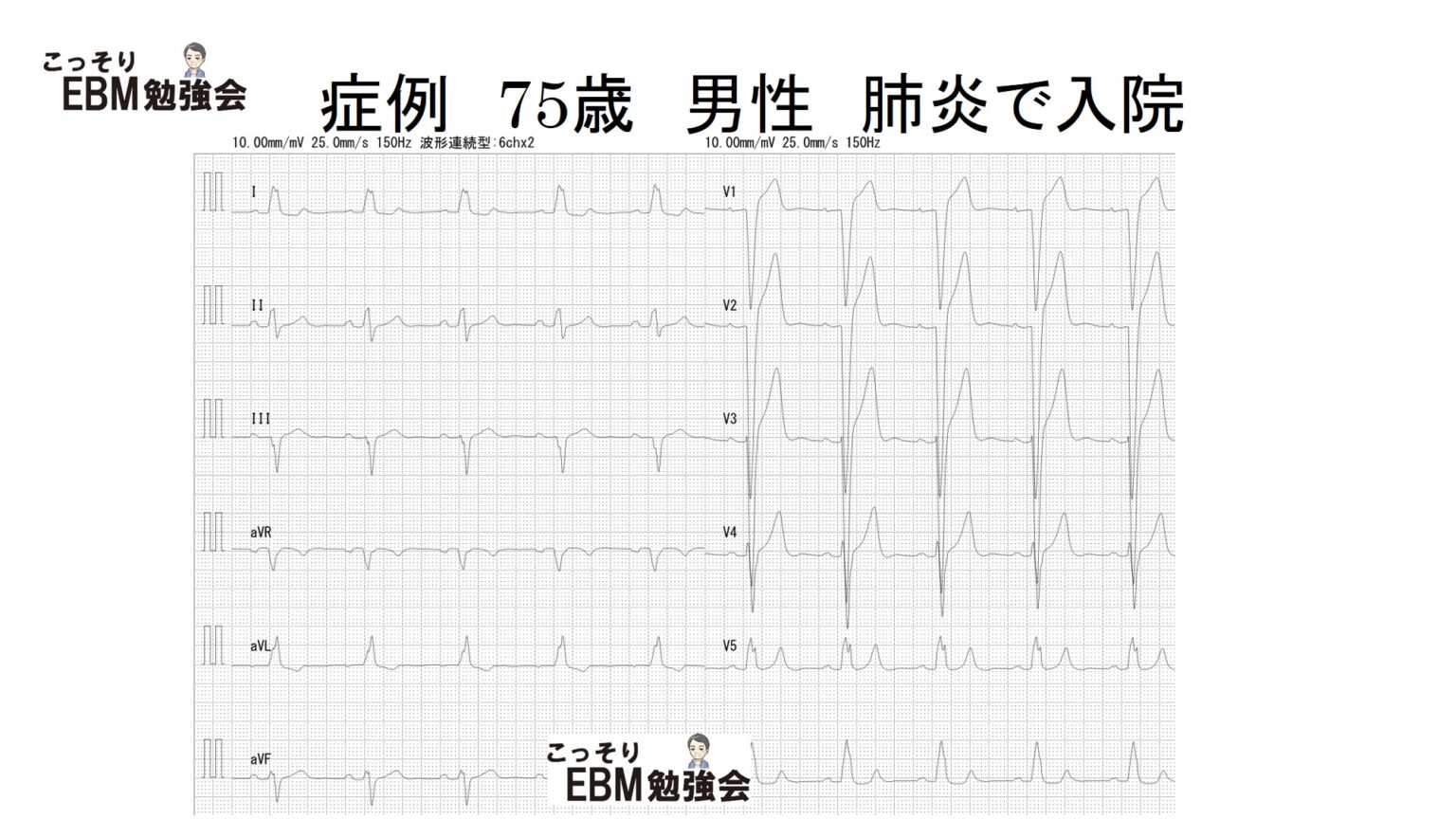 分かる!左脚ブロックの心電図 こっそりEBM勉強会