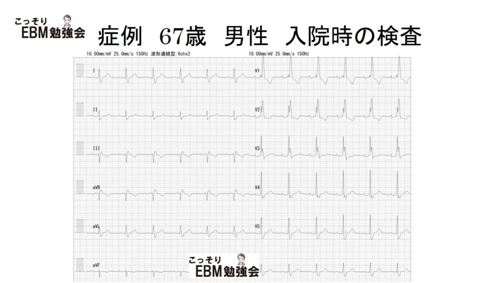 分かる！右脚ブロックの心電図 | こっそりEBM勉強会