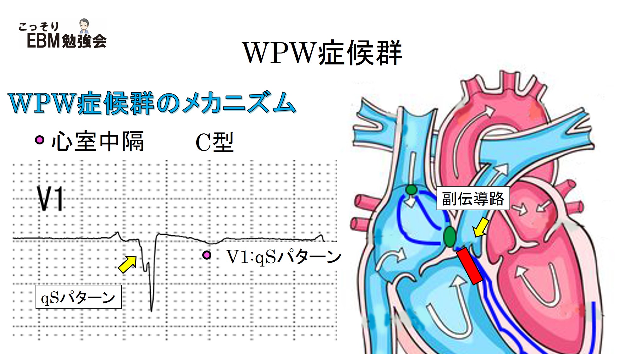 分かる！WPW症候群の心電図